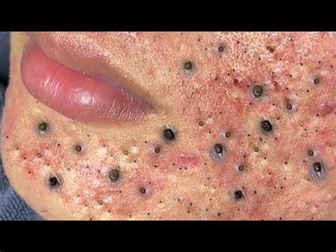 Squeezing big blackheads youtube. Things To Know About Squeezing big blackheads youtube. 
